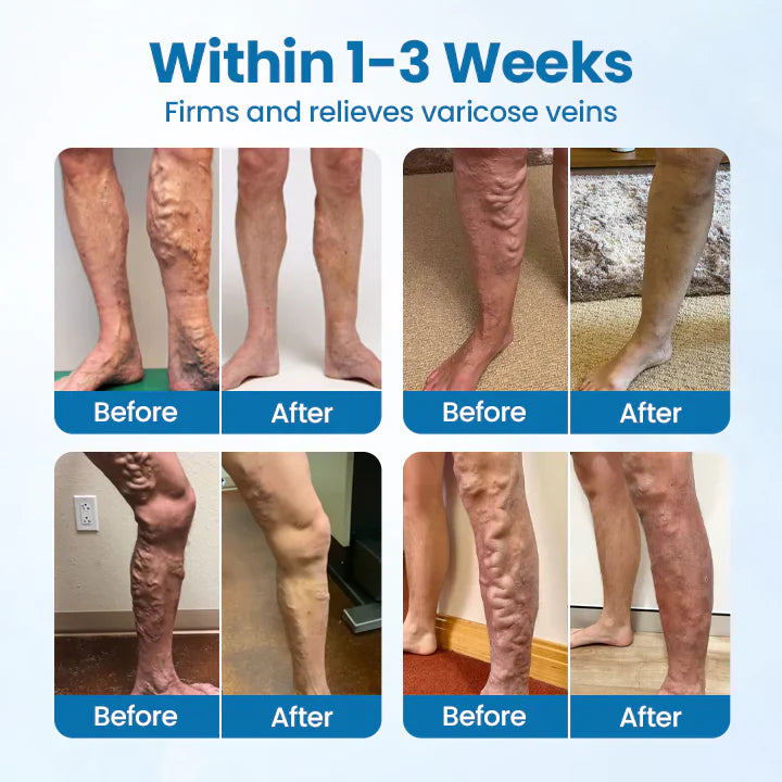 Spray de ervas Timilk® VeinGuard - ✅ Clinicamente comprovado que elimina varizes em apenas 7 dias!