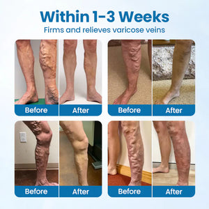 Spray de ervas Timilk® VeinGuard - ✅ Clinicamente comprovado que elimina varizes em apenas 7 dias!