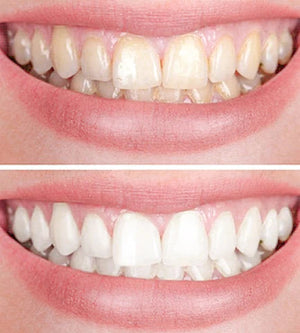 Clareador Dental Viya White  - PROMOÇÃO COMPRE 1 LEVE 2  (50% DE DESCONTO)