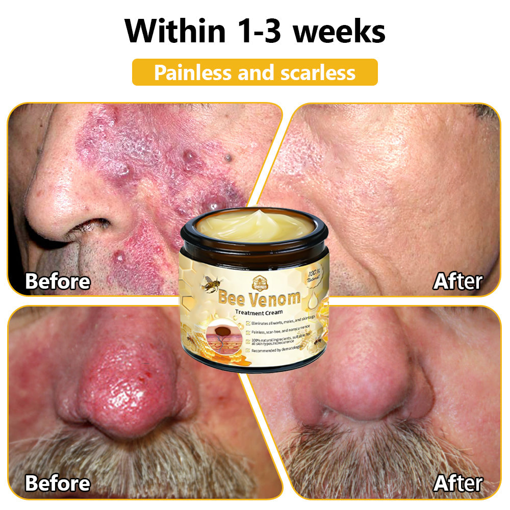 BSWELL™ Bee Venom Creme de tratamento para pele. PROMOÇÃO  - 4 Potes (Compre 2 Leve 4 )
