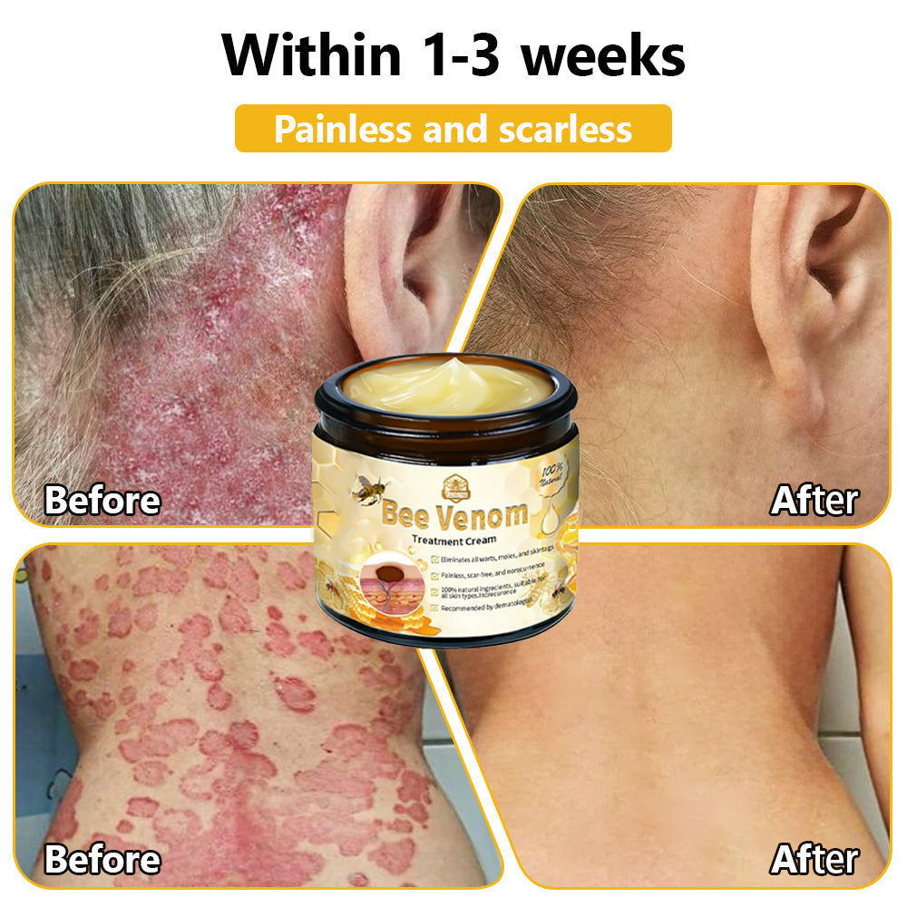 BSWELL™ Bee Venom Creme de tratamento para pele. PROMOÇÃO  - 4 Potes (Compre 2 Leve 4 )