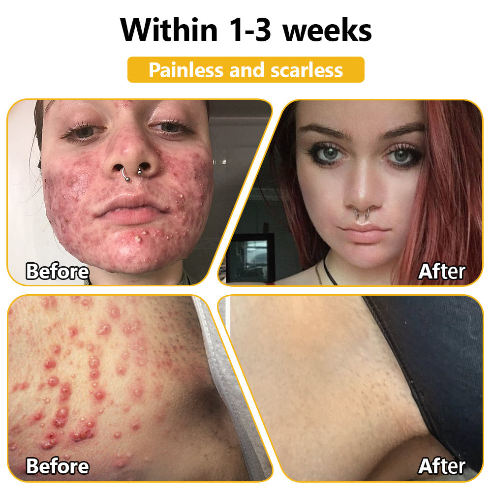 BSWELL™ Bee Venom Creme de tratamento para pele. PROMOÇÃO  - 4 Potes (Compre 2 Leve 4 )