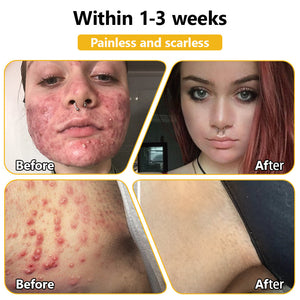 BSWELL™ Bee Venom Creme de tratamento para pele. PROMOÇÃO  - 4 Potes (Compre 2 Leve 4 )