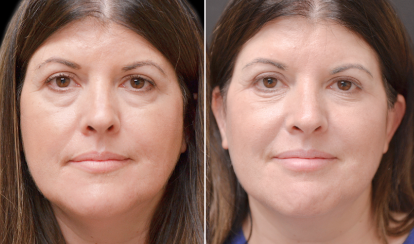 BotoxLux™ Creme Lifting com Peptídeos