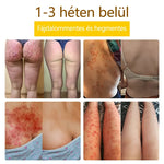 flysmus™🐝: eczema, psoríase, acne, rosácea, infecções fúngicas, verrugas