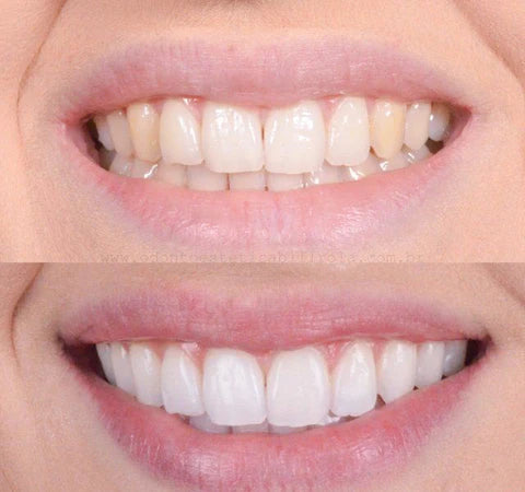 Clareador Dental Viya White  - PROMOÇÃO COMPRE 1 LEVE 2  (50% DE DESCONTO)