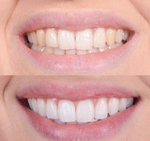 Clareador Dental Viya White  - PROMOÇÃO COMPRE 1 LEVE 2  (50% DE DESCONTO)