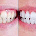 Clareador Dental Sorriso Max