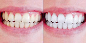 Clareador Dental Sorriso Max