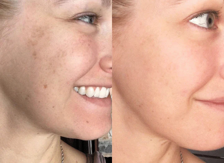 Turmeric Sérum® - Corretor de Manchas Escuras e Melasma PROMOÇÃO (50% DE DESCONTO)